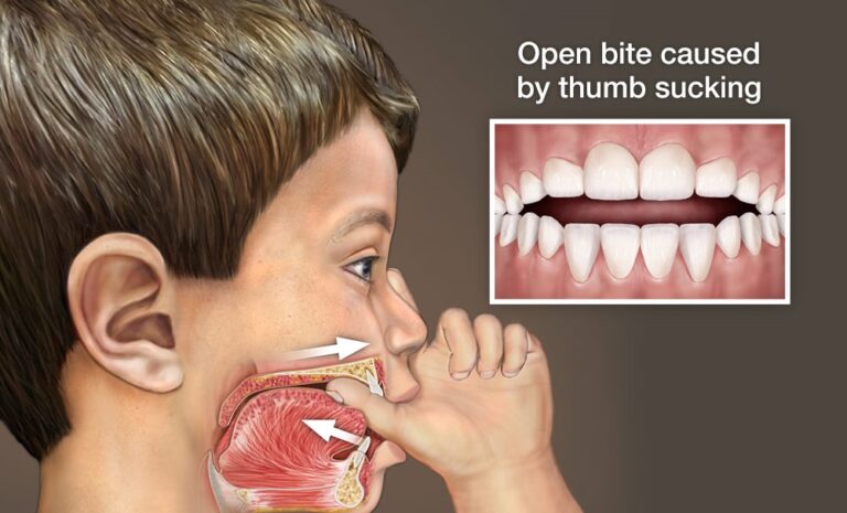 Pacifier Vs Thumb Sucking