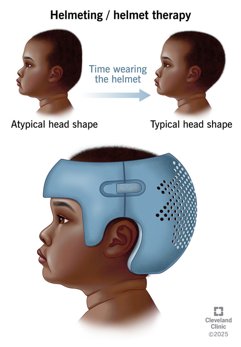 Newborn Positional Skull Development