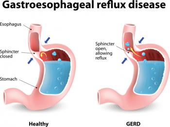 Newborn Gastroesophageal Reflux Development